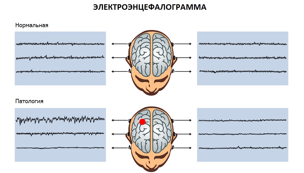 электроэнцелофалограмма головного мозга (ээг) норма и нарушения